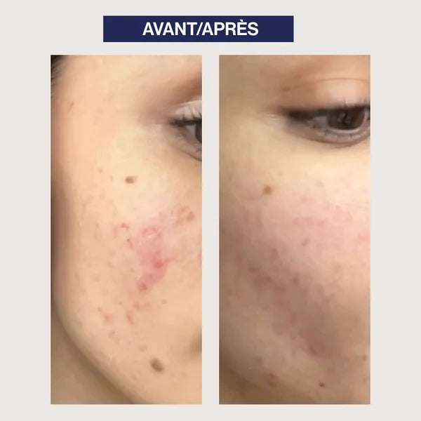 Balance Your Pores – Anti Blemish