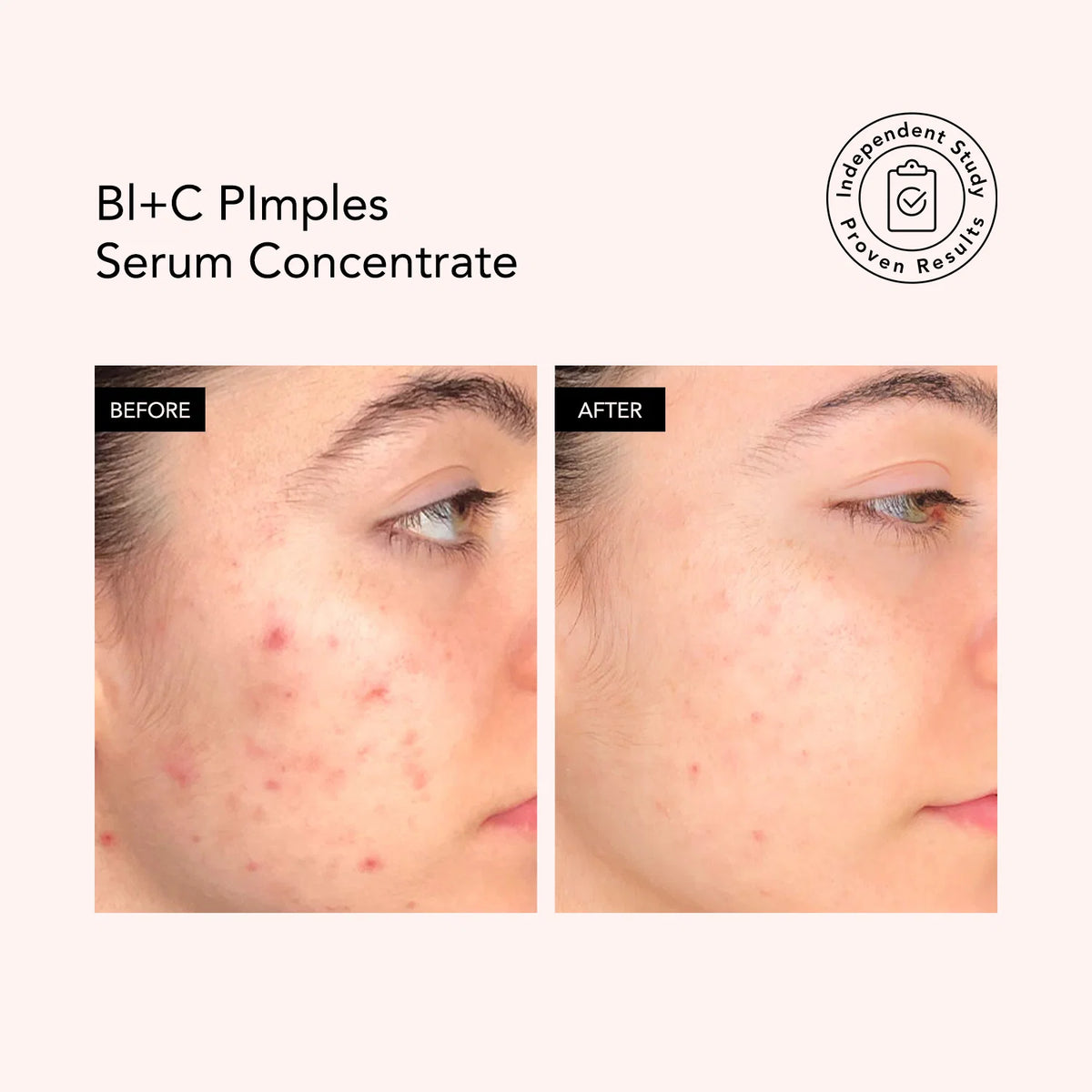 BL+C Pimples Black Cumin + Cajeput Serum Concentrate